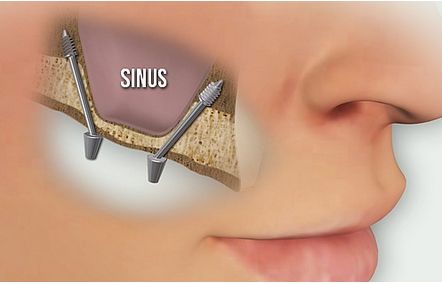 Without sinus lift