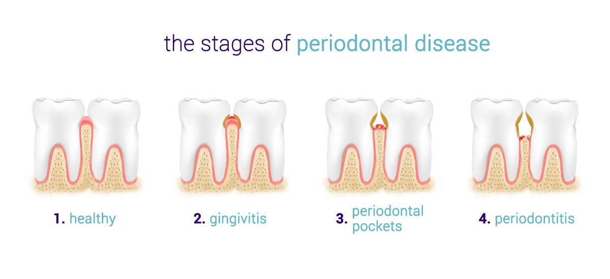 Periodontal gum disease: the `Silent Killer` | 5 day implant system