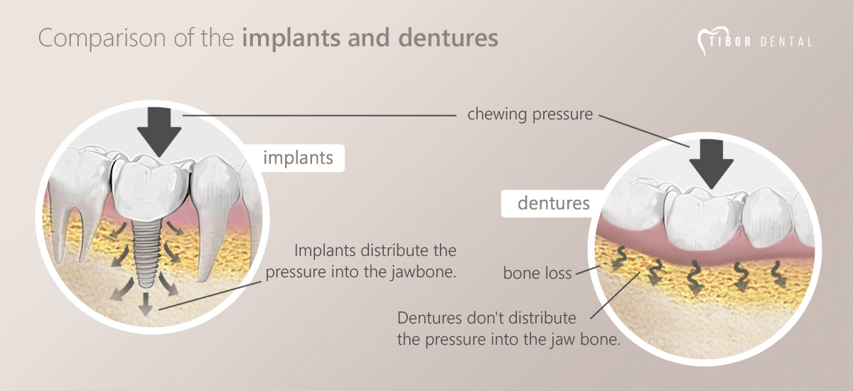 Comparison of the implants and dentures