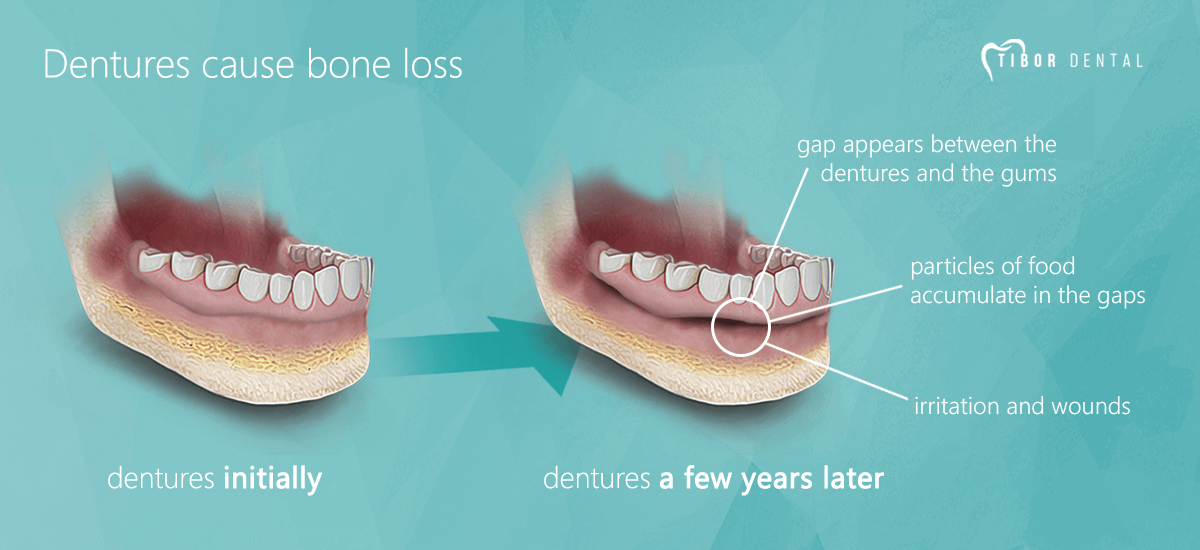 dentures cause problems fitting ill cancer why while bone loss jaw teeth caused implant implants speaking system which additional move