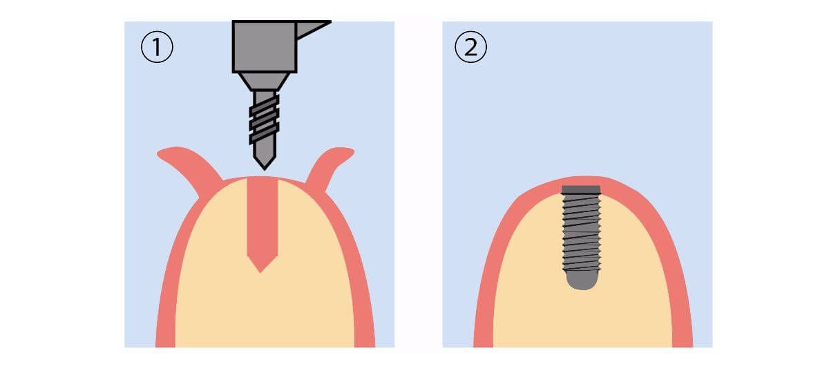 Determining the place of the implant