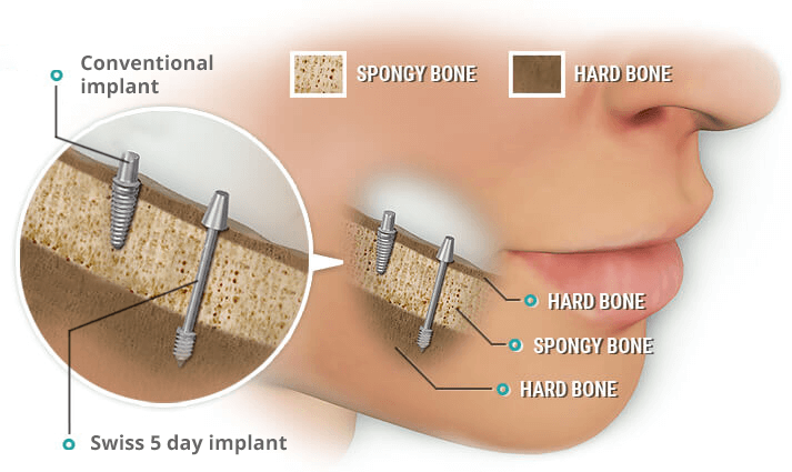 Conventional implants vs. Swiss implant system