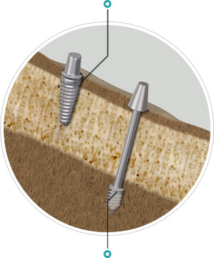 Conventional implants vs. Swiss implant system
