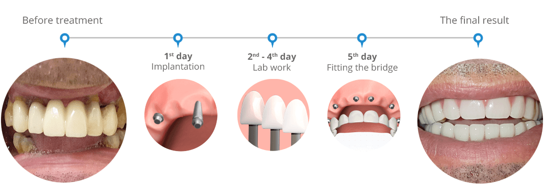 Swiss 5 day dental implant system - before and after