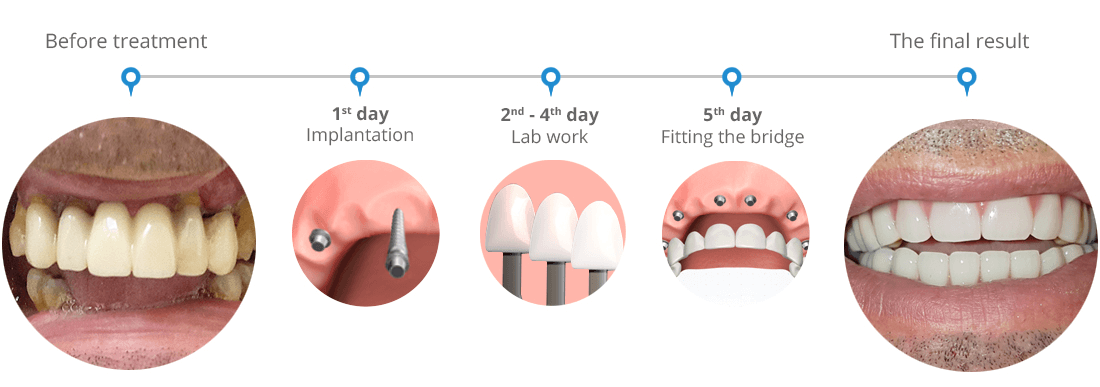 Swiss 5 day dental implant system - before and after