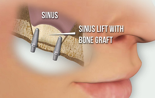 Implant and sinus lift